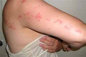 Picaduras de chinches de cama: síntomas, riesgos y cómo tratarlas